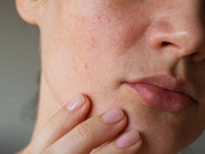 Pori Pori Wajah Membesar Begini Cara Mengecilkannya Indozone Id Line Today