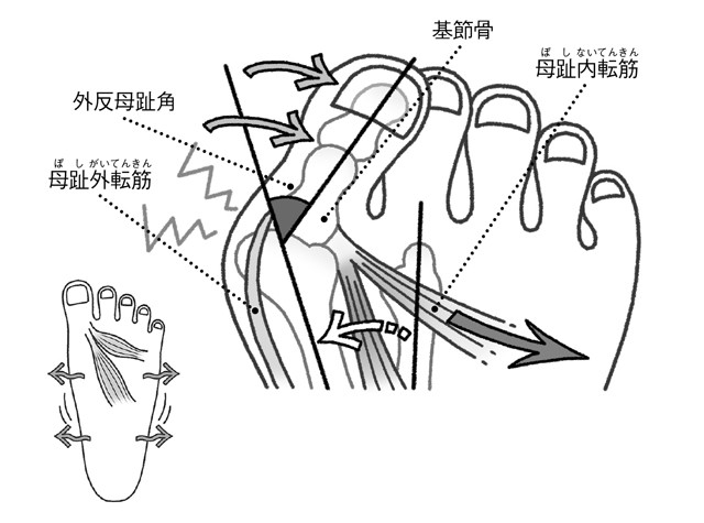 アーチの崩れが招く 足の構造から知る 外反母趾 の仕組み