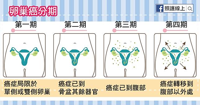 經常無聲無息的 卵巢癌 懶人包 照護線上 Line Today