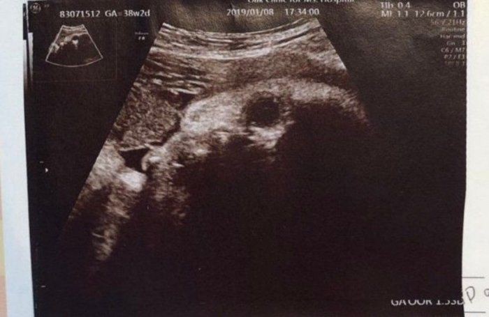 人工授精 体外受精を経て出産 エコーで愛おしさが増加