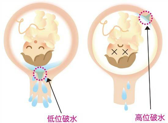 懷孕30週就破水 高位破水 分泌物還是漏尿 3招教你分辨 Mamibuy媽咪拜 Line Today