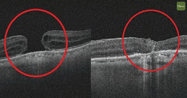 眼前一黑 竟是黃斑部裂洞別怕 8成病人這樣治療能痊癒 Heho健康 Line Today