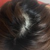 本気の薄毛、AGA、FAGA対策