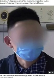 カニ好きの男性 肺に細長い寄生虫が発見される 中国