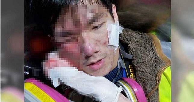 浸大學生記者「顴骨中彈」右眼噴血　急救員怒批：故意瞄準他們