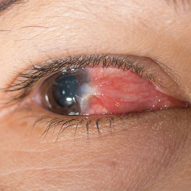 眼癢難耐 春季好發 過敏性結膜炎 三招預防 媽媽經 Line Today