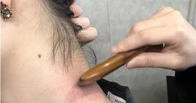 36歲男刮痧完「視力模糊」腦中風！　醫曝危險地方：別亂按