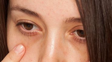 黑眼圈眼袋消不掉，原來是因為「子宮太寒」！中醫師：多吃它+按摩眼睛這8穴道