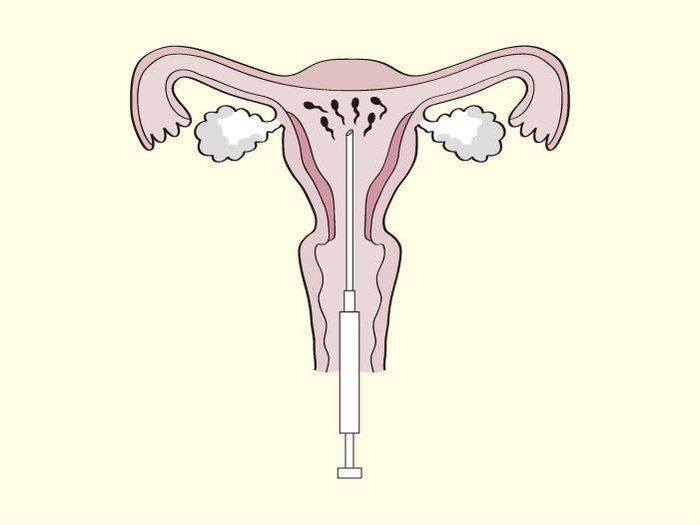 妊娠中トラブル カンジタ膣炎 腰痛 妊娠高血圧症候群