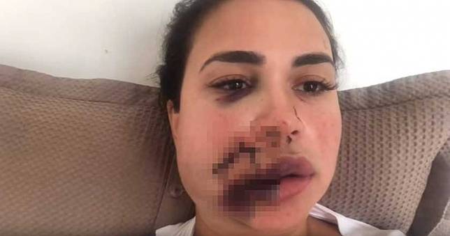 太美被嫉妒！27歲小模遭「酒杯砸臉」噴血　慘縫90針毀容