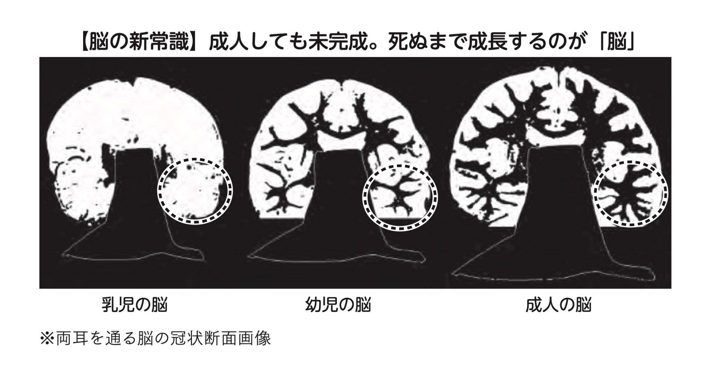 若くして認知症に 40代後半で一気に脳が老ける人の頭の中で起きていること