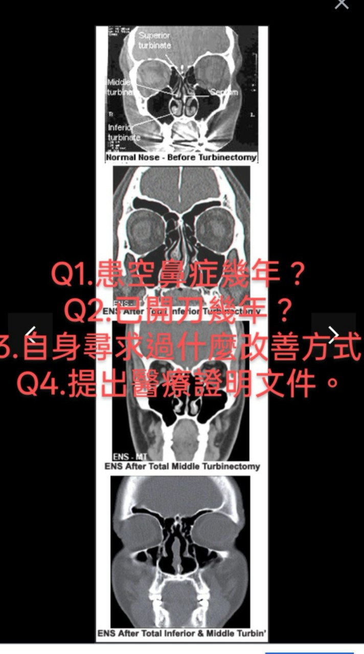 空鼻症患者