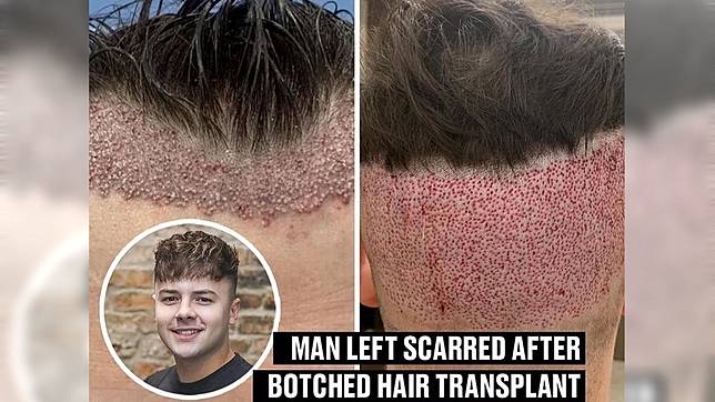 26岁男花4 7万植发 头皮长满这个东西超吓人 真实新闻时事动态 钧天