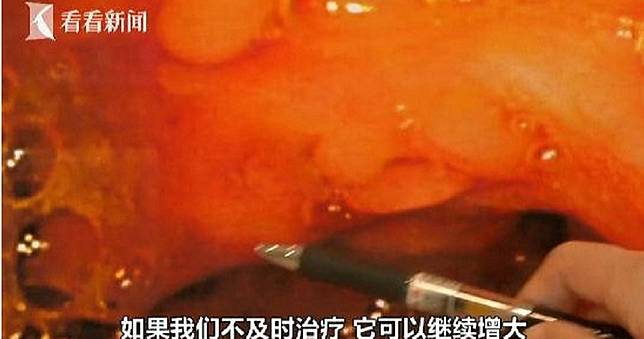 男腸胃長滿「60顆肉色珍珠」　醫揭「關鍵原因」現代人都中槍！