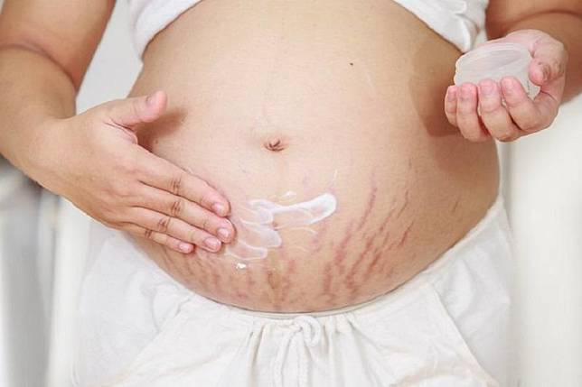 Stretch Mark Saat Hamil Bikin Bunda Pusing Ini Cara Menghilangkannya Arusinfo