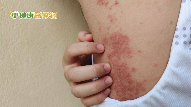 研究者はマイクロバイオームとHSとの関係について何を知っていますか?