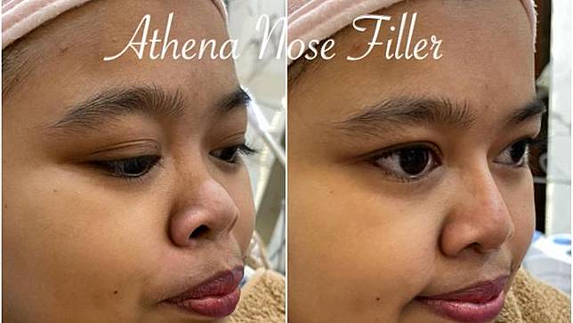 Siap Grak Filler Hidung Yang Dilakukan Kekeyi Termasuk Operasi Plastik