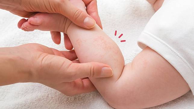 8 Ciri Bayi Alergi Susu Sapi Pahami Ya Moms Orami Magazine Line Today