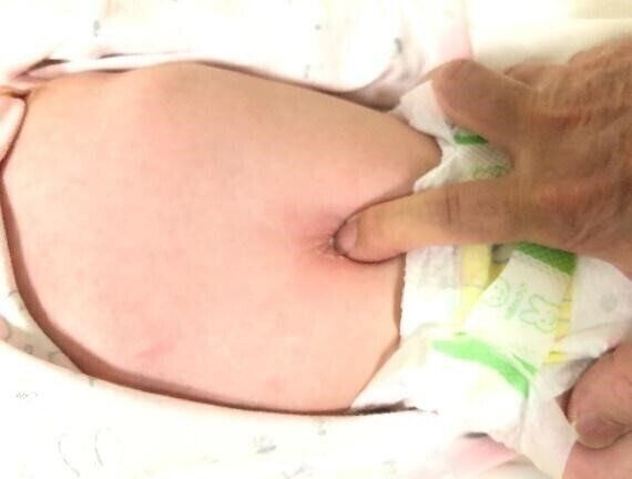 赤ちゃんのでべそ治療はオーダーメード 小児科医