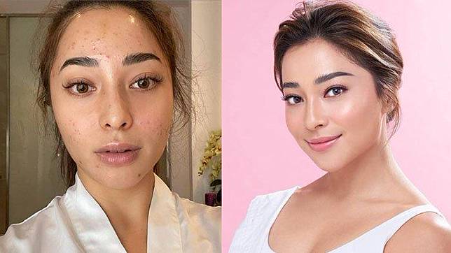Sempat Jerawatan Parah Nikita Willy Insecure Hingga Takut Terima Job Ngaku Nangis Setiap Malam Tribun Style Line Today