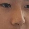 ニキビ相談会