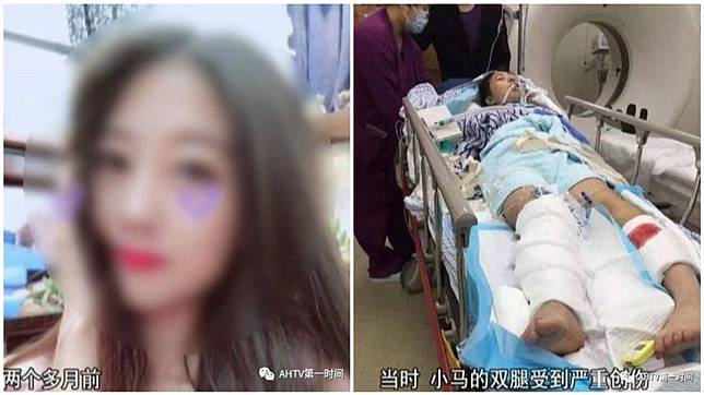 安徽1名正妹去相親時被，男方執意酒駕載她回家，沒想到途中出車禍和女方右腳被截肢。(圖／翻攝自陸網)
