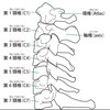 頸椎椎間板ヘルニア