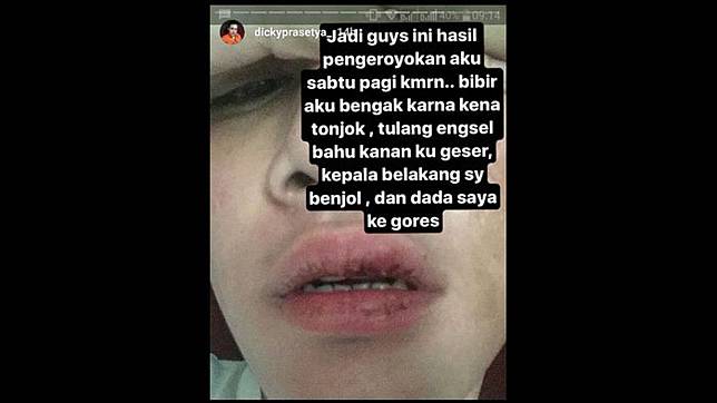 Dicky SMASH - 5 Fakta Peristiwa Pengeroyokan yang Menimpanya, Tulang Bahu Sampai Geser!