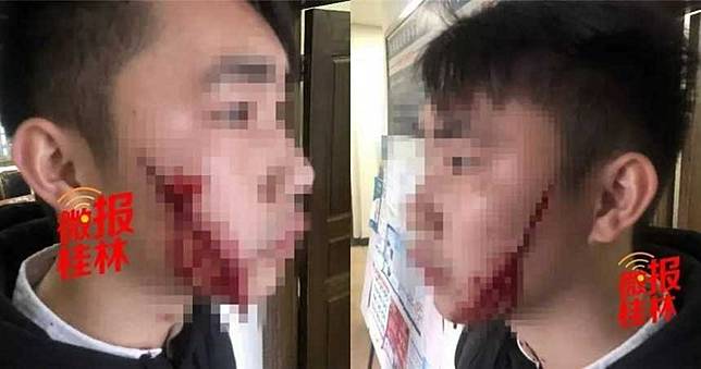 不爽被分手！女假裝相擁道別　下秒亮刀狠劃男友兩頰20cm