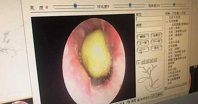 8歲童好奇把綠豆塞耳朵　耳痛忍2天醫一看「快發芽了」