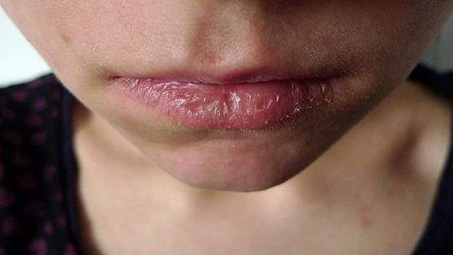 Meski Sepele Mengelupas Kulit Bibir Ternyata Bisa Timbulkan 3 Hal Buruk Ini Teen Co Id Line Today