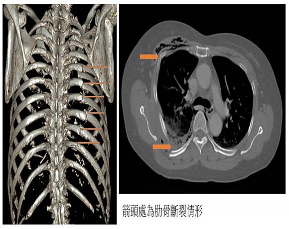 婦人樓梯跌落斷12根肋骨鈦合金骨折固定術防肺臟損傷 中廣新聞網 Line Today