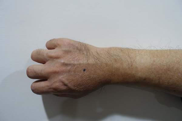 舒利渼SureMed超薄型傷口隱形貼，傷口怕碰水?傷口怕留疤?舒利渼人工皮OK蹦防水、透氣、很薄、服貼，最長可貼5天洗澡、游泳都OK 