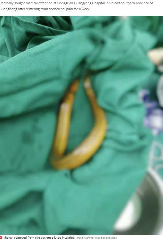 便秘に効く と肛門からウナギを挿入した男性 腸を突き破られ危険な状態に 中国
