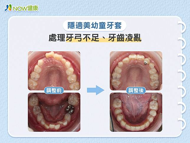 把握矯正齒列不正與戽斗的黃金時期！醫師分析治療趨勢