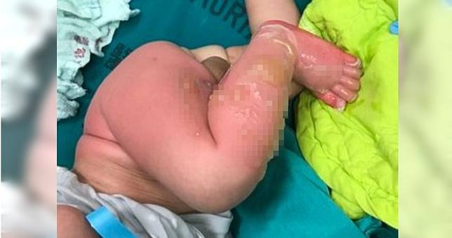 保母抱男嬰浸熱水「皮掉一層」　父泣訴：腳趾頭恐保不住