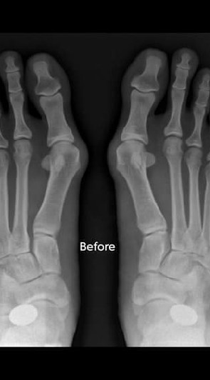 Non-Bone Breaking Bunion Surgery 非切骨拇指外翻手术