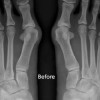 Non-Bone Breaking Bunion Surgery 非切骨拇指外翻手术