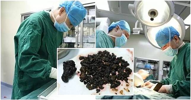 Dokter Temukan 200 Batu dalam Tubuh Wanita Ini, Ada yang Sebesar Telur