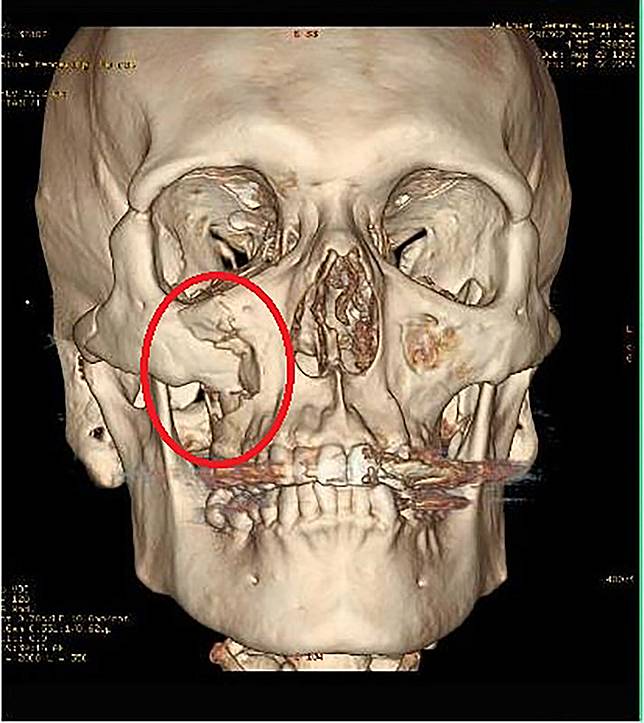 失足摔成顏面骨折男業務手術復位重拾俊俏臉 中央通訊社 Line Today
