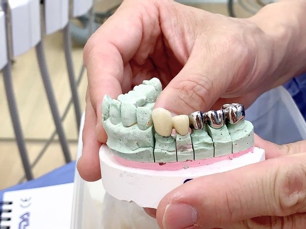 「台中植牙」太平牙醫推薦，全家牙齒守護最佳首選-台中市北屯區星星牙醫診所直擊分享