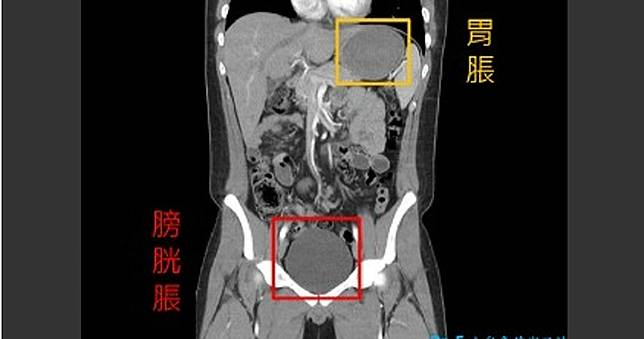 高中生挑戰「無敵麻辣麵」腹痛尿不出送醫！參賽原因讓醫傻眼
