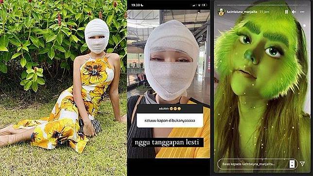 AKHIRNYA Perban Lucinta Luna Dibuka, Wajah Pascaoperasi Plastik Terkuak