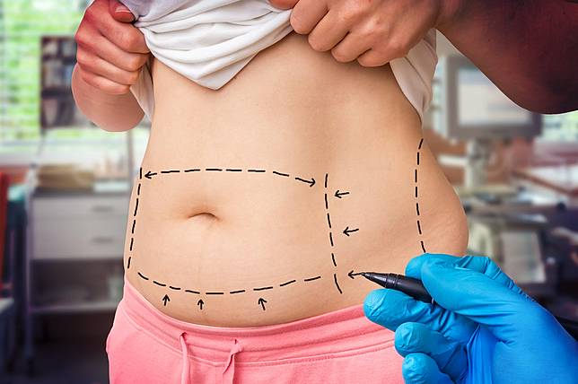 Mengenyahkan Lemak Tubuh dengan Cara Instan