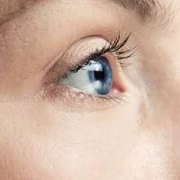 กลุ่มโรคกระจกตาโป่ง (Keratoconus)