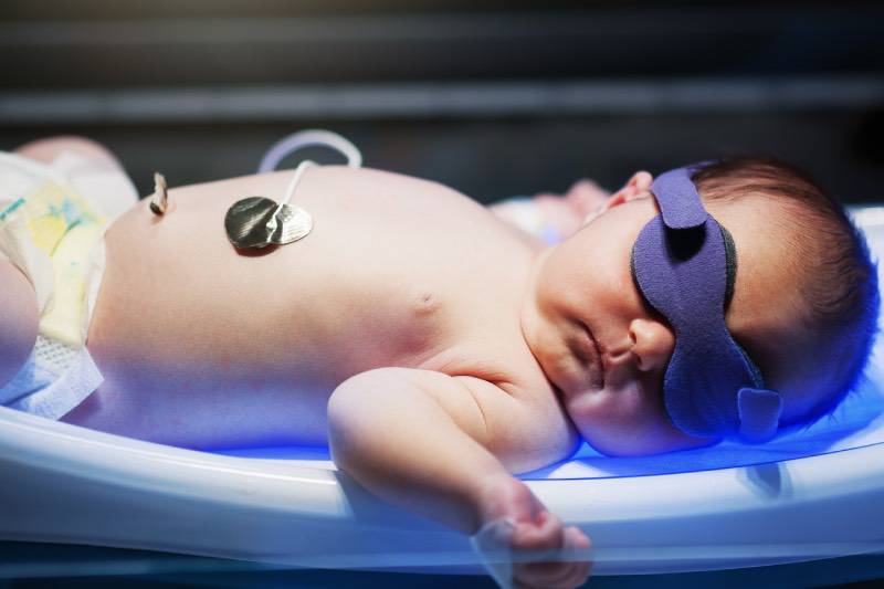How To Heal Jaundice In Newborn At Home