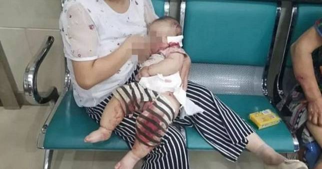 鄰居狗衝出　1歲男嬰「半臉被咬掉」！母哭喊：狗為何不栓好