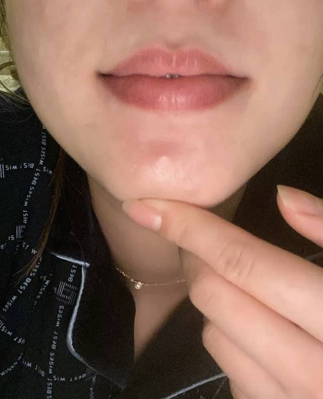 6個石頭瘡急救方法 下巴長紅腫閉口瘡 網民發現這款藥油消紅消腫即時效果超好 Cosmopolitan Hk Line Today