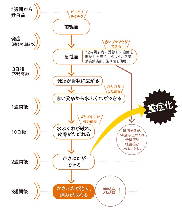 疱疹 経過 帯状 帯状疱疹とは