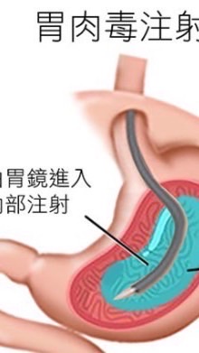 胃内肉毒桿菌注射/水球置放減重經驗分享